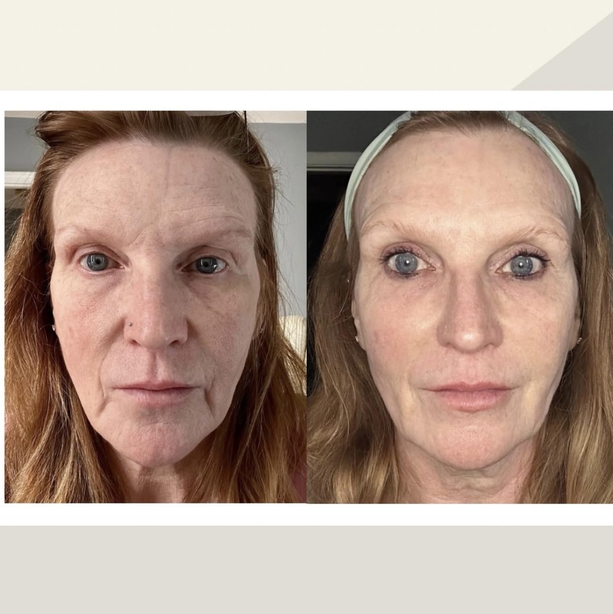 7E Wellness MyoLift Mini Microcurrent Facial Device with Dual Probes | Compact rechargeable microcurrent facial device with dual probes for face and neck skincare routines customer photo 1
