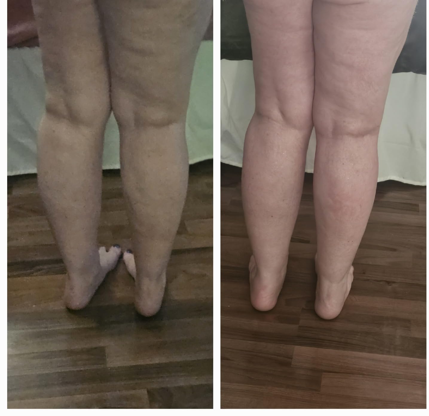 CXGRISE Body Shaping Machine Belly Arm Cellulite Stretch Mark Massager Tightening Device for Leg Ideal Gift for Mom customer photo 2